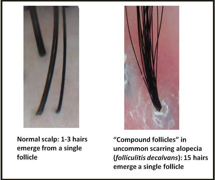 Why do multiple hairs grow from the same follicle
